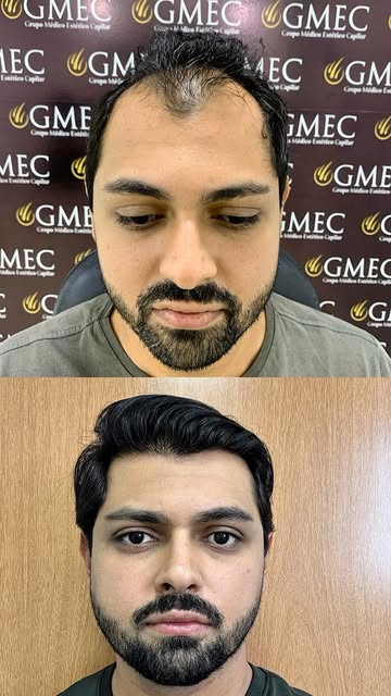 Comparação de antes e depois publicada no perfil oficial da GMEC Chapecó, mantida sem retoques